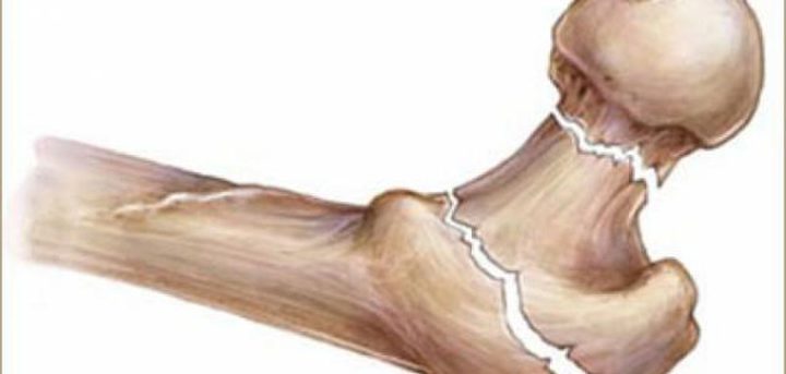 هشاشة العظام من قلة النوم